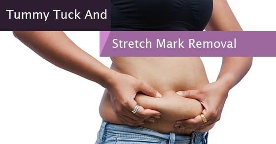 Tummy Tuck And Stretch Mark Removal