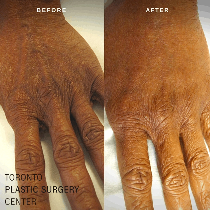 Hand Rejuvenation Toronto Plastic Surgery Center Dr. Pirani