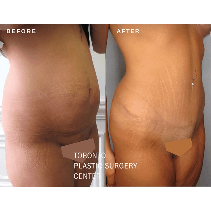 Tummy Tuck (Abdominoplasty), Main Line Plastic Surgery