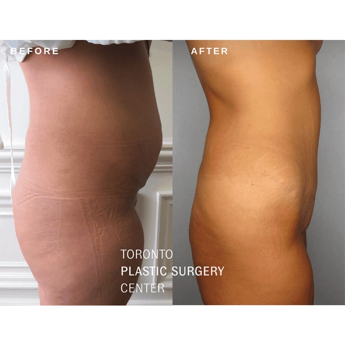 ABDOMINOPLASTY TWO MONTHS POST OP - Instant Loss - Conveniently Cook Your  Way To Weight Loss