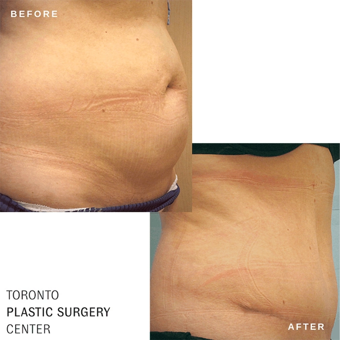 Tummy Tuck Surgery Toronto, Abdominoplasty