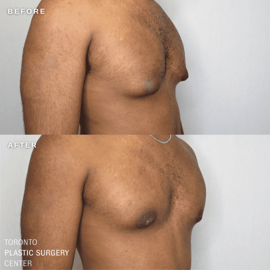 Gynecomastia in Toronto (Male Breast Reduction)