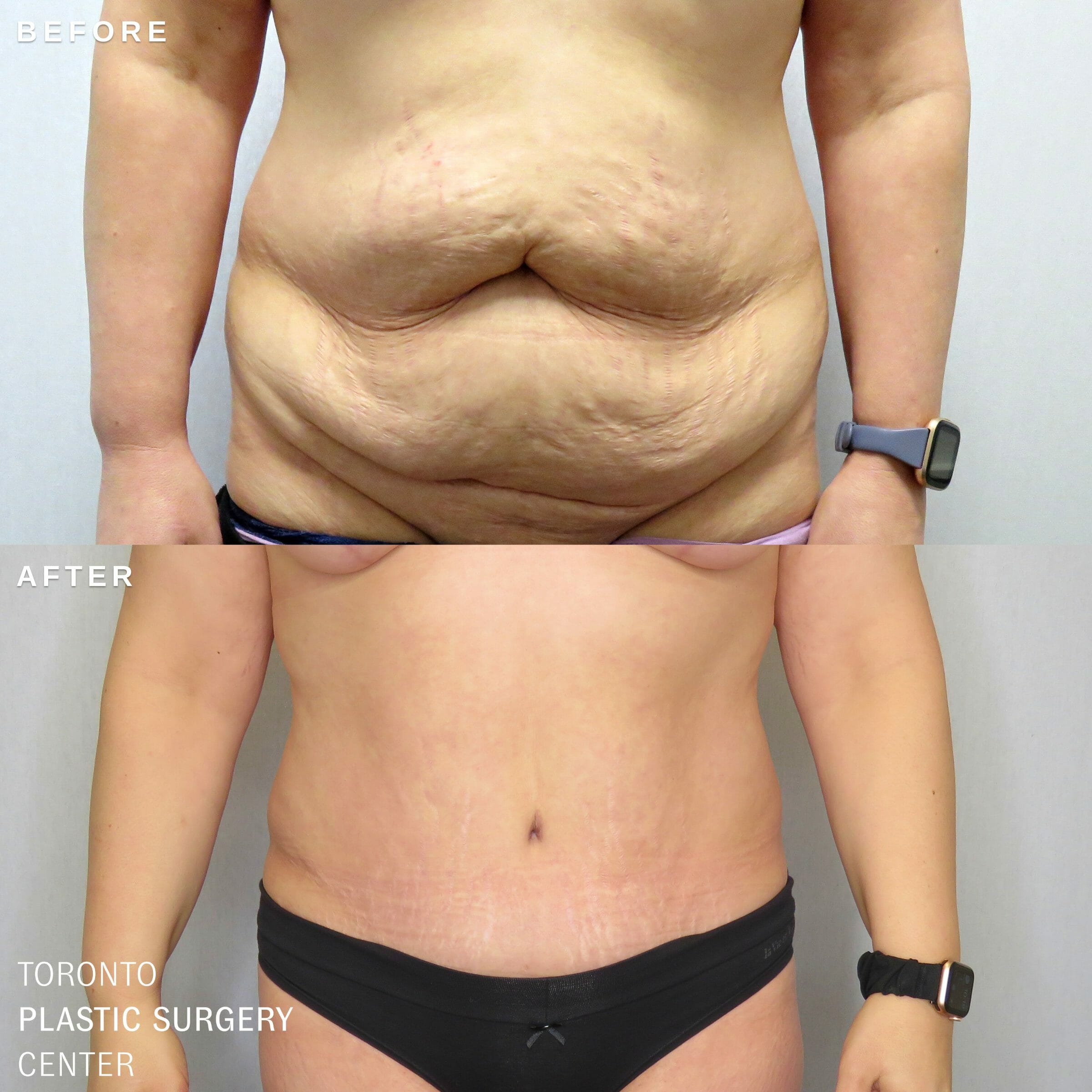 Tummy Tuck (Abdominoplasty) - Toronto Cosmetic Surgery