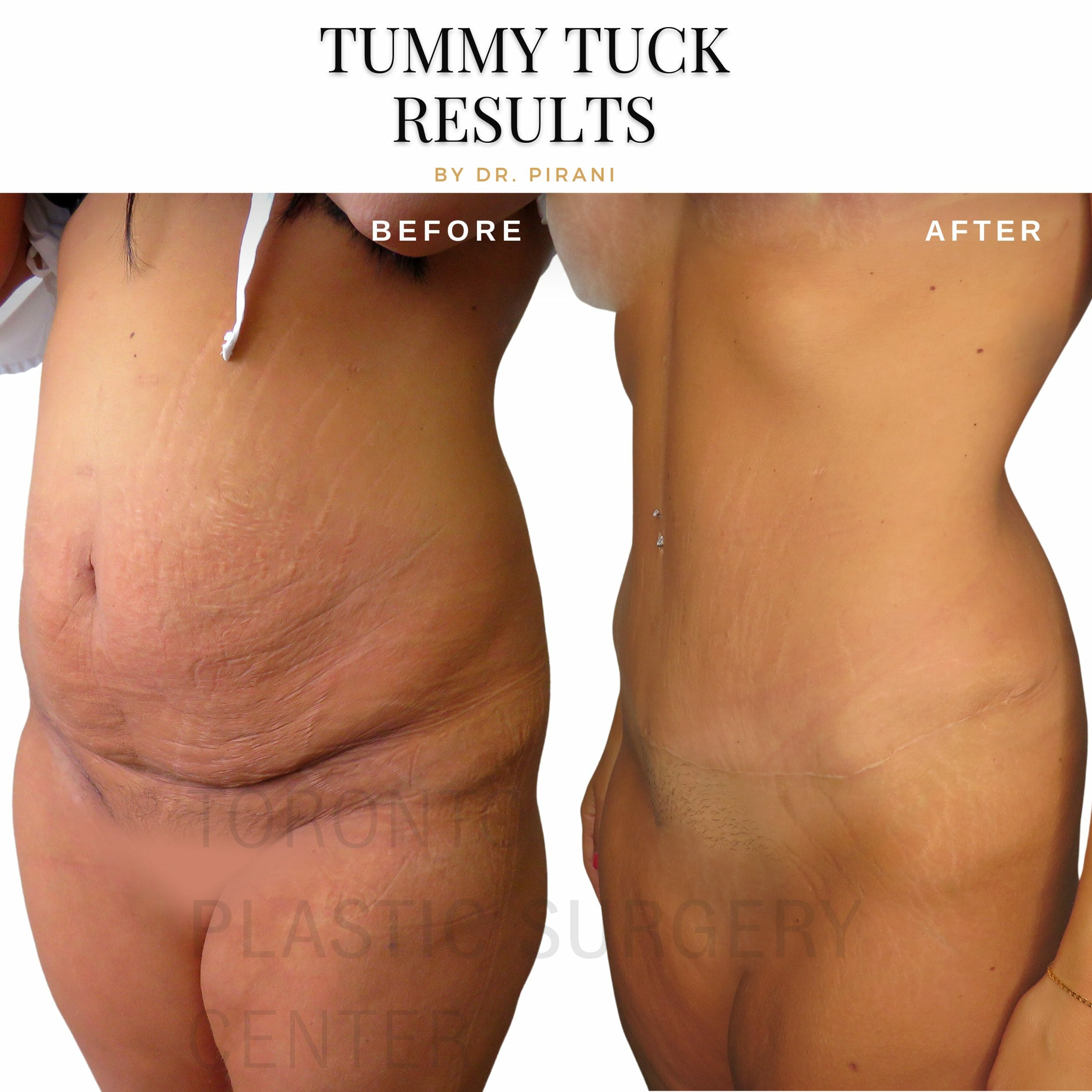 Tummy Tuck (Abdominoplasty) Mississauga Toronto ON