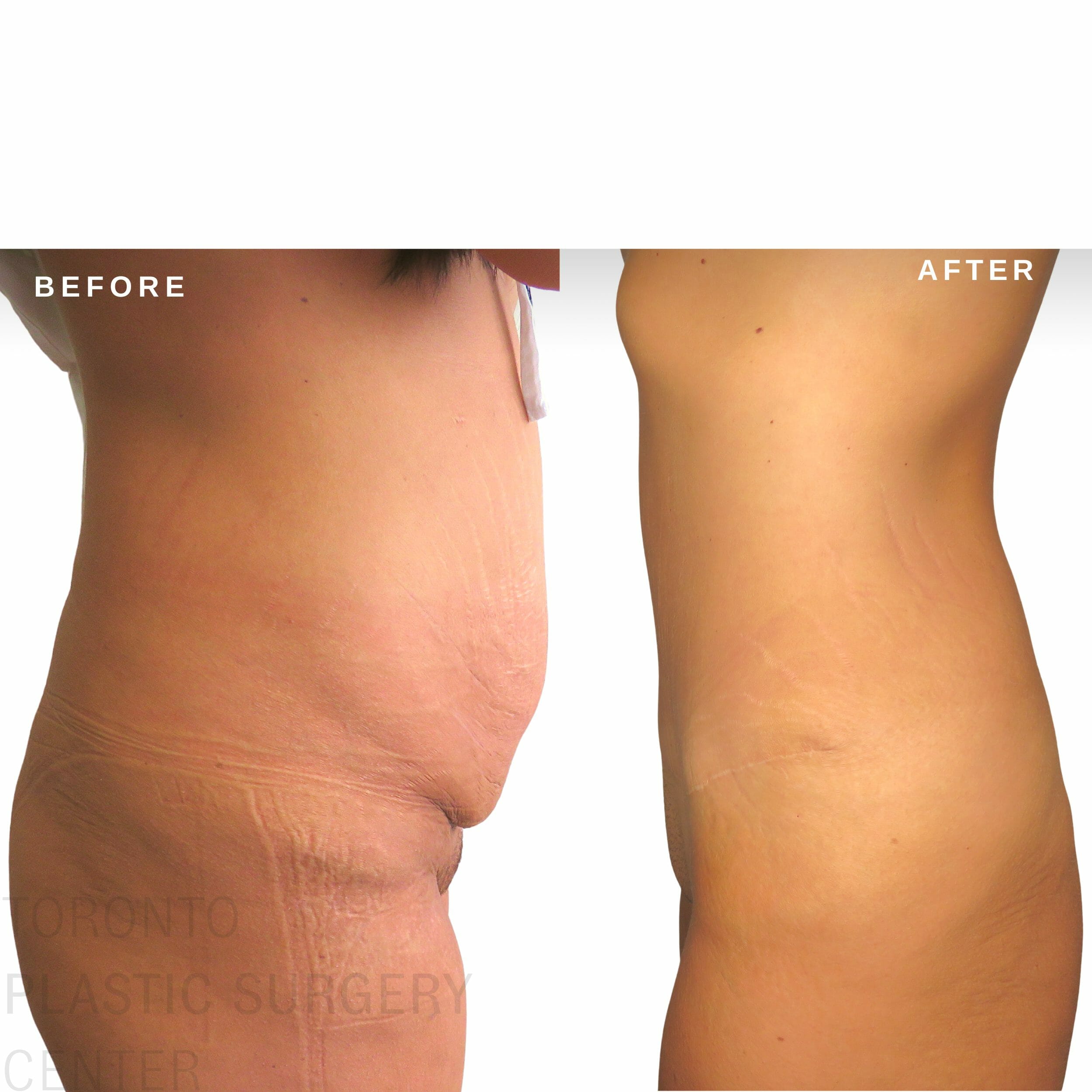 Toronto Liposuction Clinic - See Costs & Before/Afters!