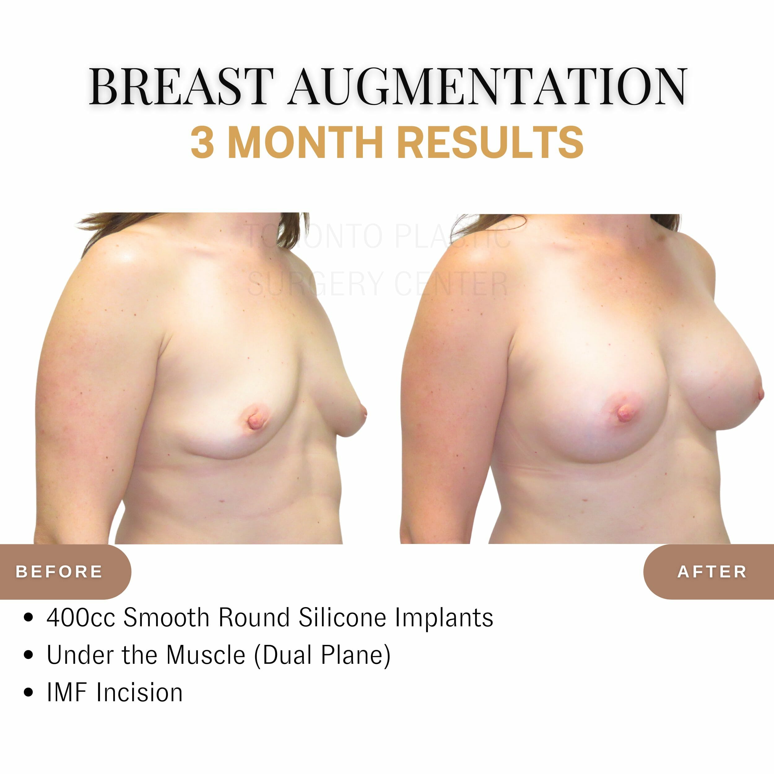Breast Asymmetry Correction in Toronto