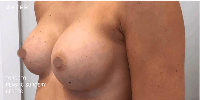 _0184_breast-augmentation-ba-28.jpg.webp
