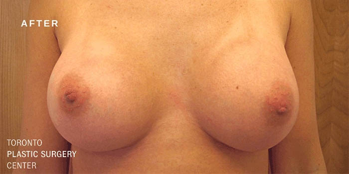 _0256_breast-augmentation-ba-71.jpg.webp