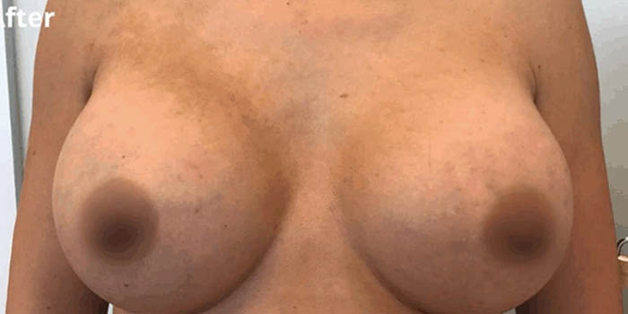 _0262_breast-augmentation-ba-76.jpg.webp