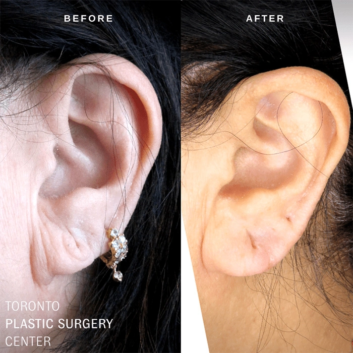 dermal-filler-ba-09.jpg