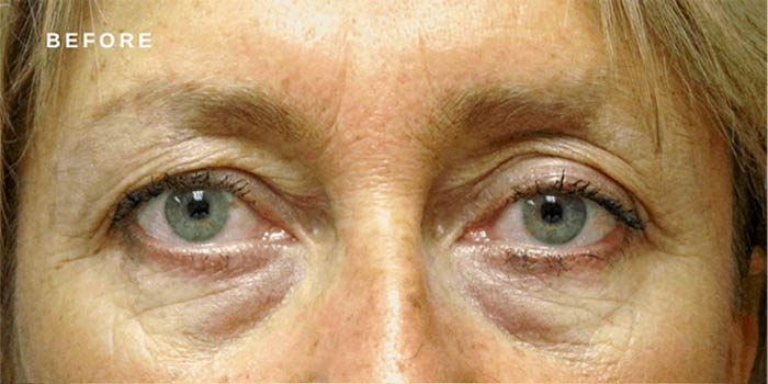 0000_brow-lift-ba-1.jpg.webp-copy