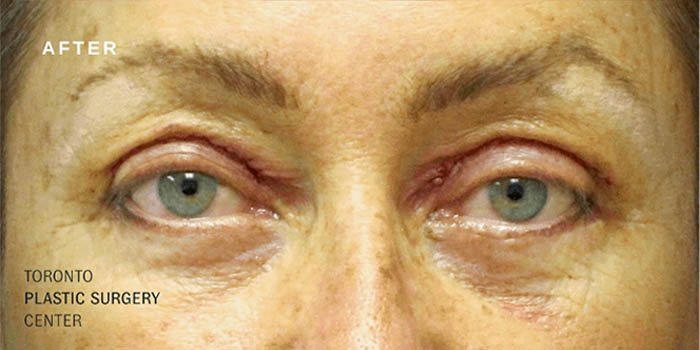 0001_brow-lift-ba-1.jpg.webp