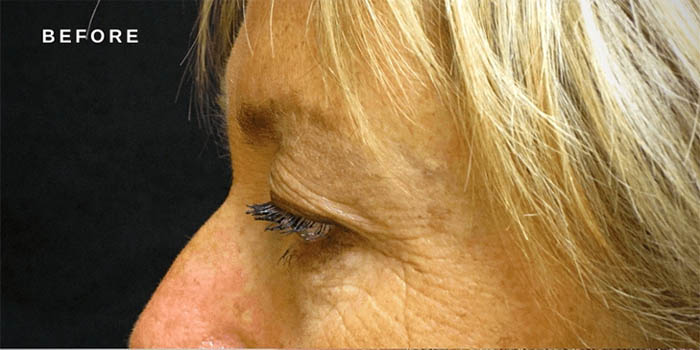 0002_brow-lift-ba-2.jpg.webp-copy