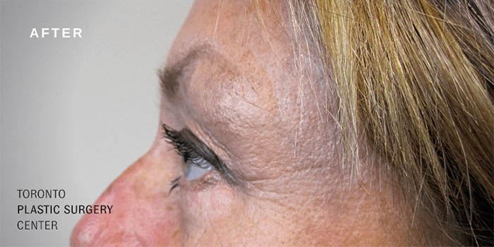 0003_brow-lift-ba-2.jpg.webp