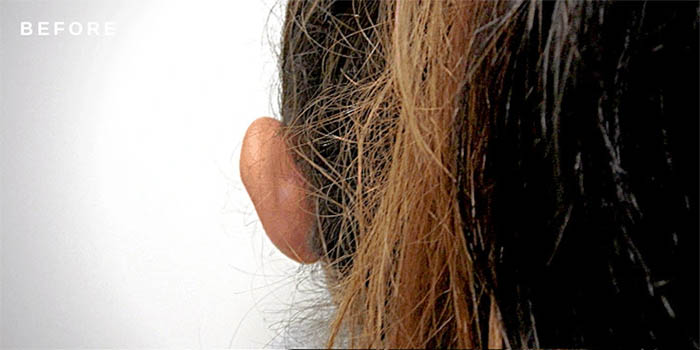 1_0026_ear-pinningba-1.jpg-copy