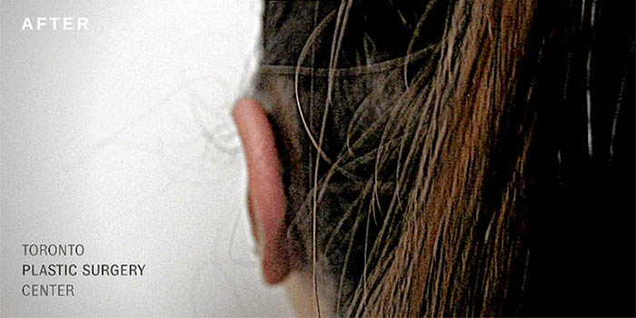 1_0027_ear-pinningba-1.jpg