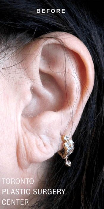 ear-lobe-filler-ba-01_0000_Layer 1