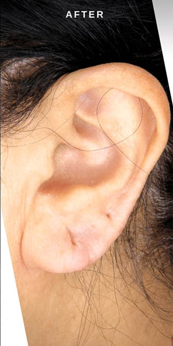 ear-lobe-filler-ba-01_0001_Layer 2