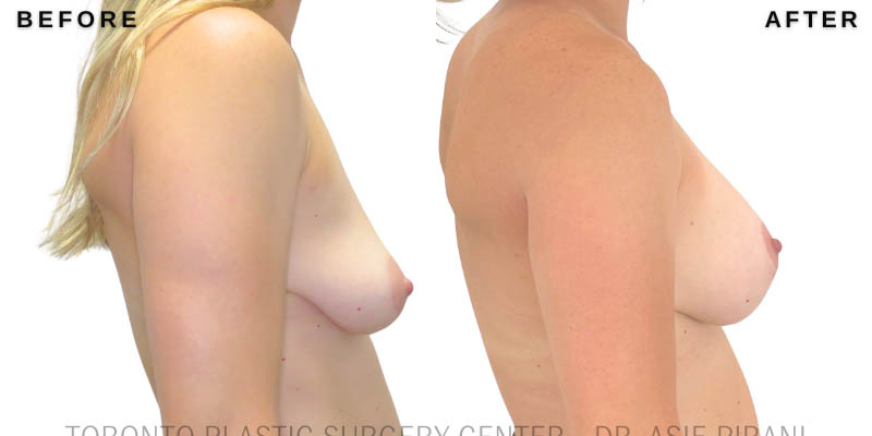 Breast_Augmentation_Mastopexy_Toronto – 4