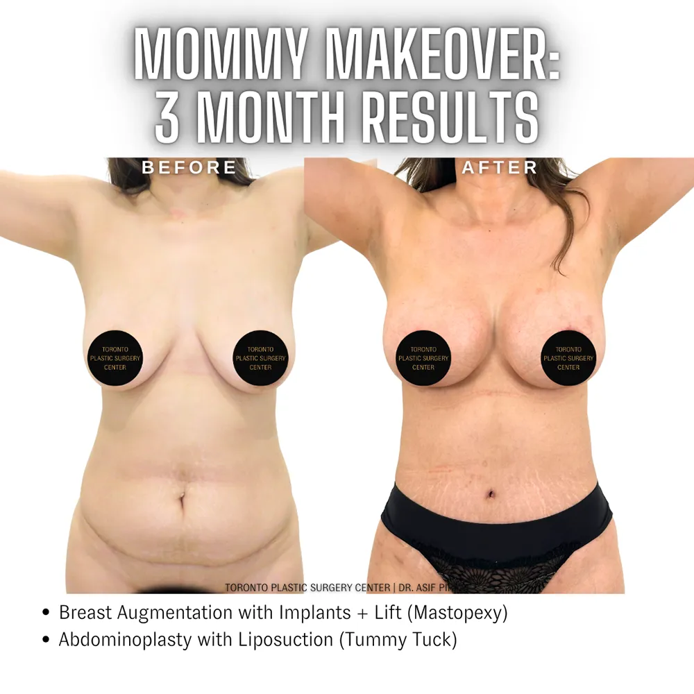 Mommy_Makeover_Toronto_Abdominoplasty1
