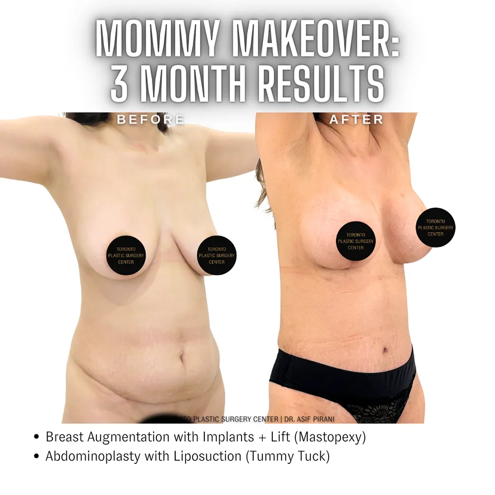 Mommy_Makeover_Toronto_Abdominoplasty2