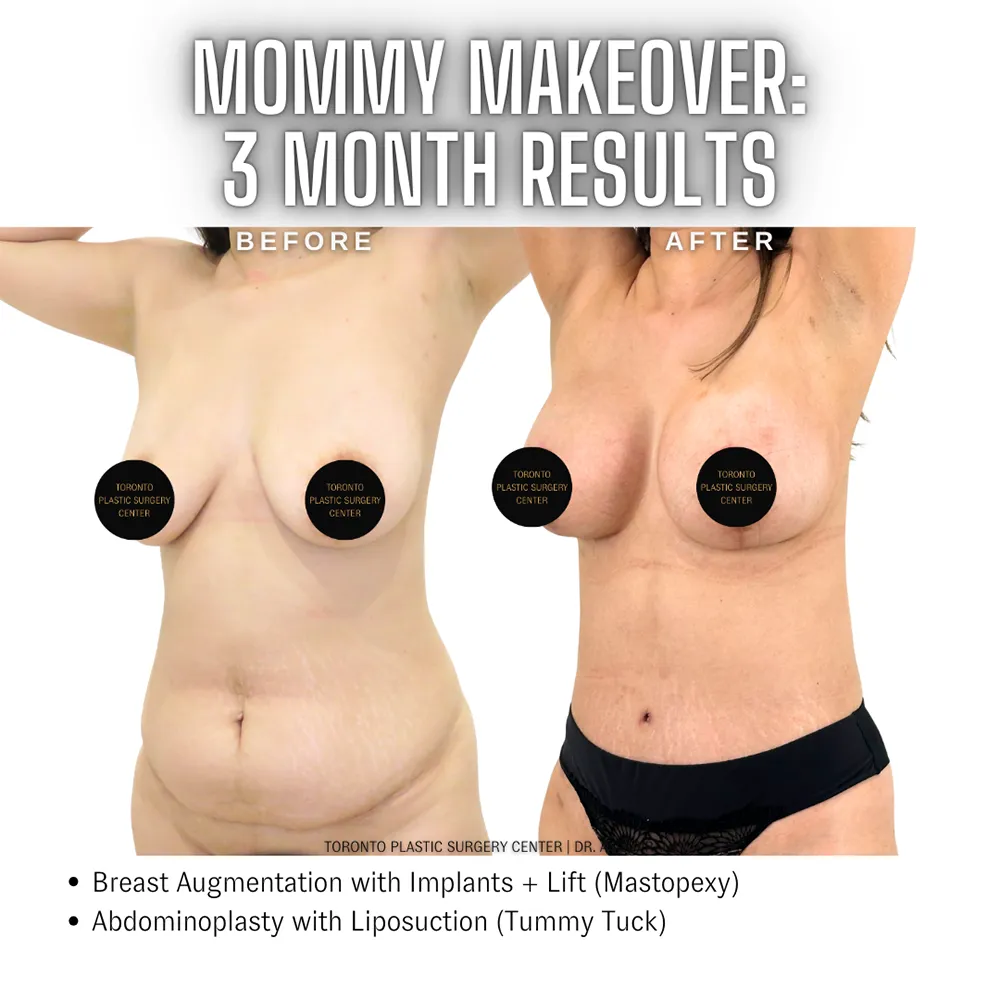 Mommy_Makeover_Toronto_Abdominoplasty3