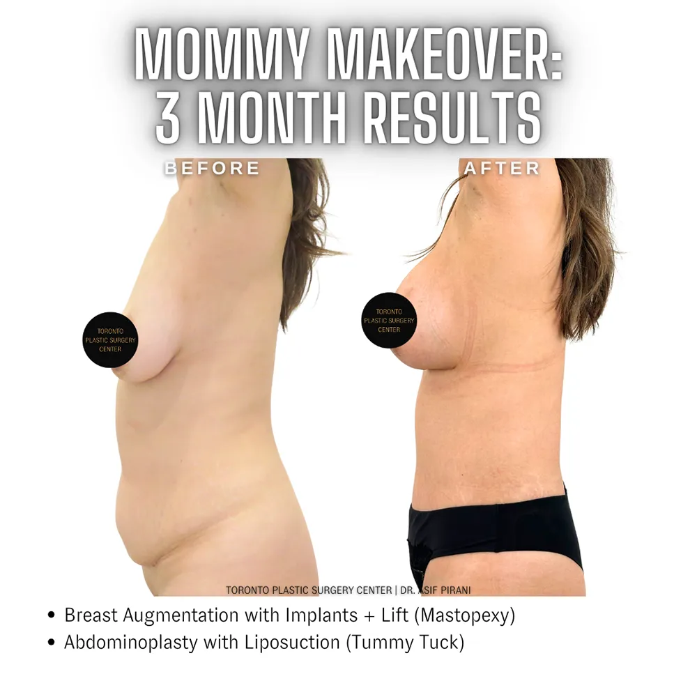Mommy_Makeover_Toronto_Abdominoplasty4