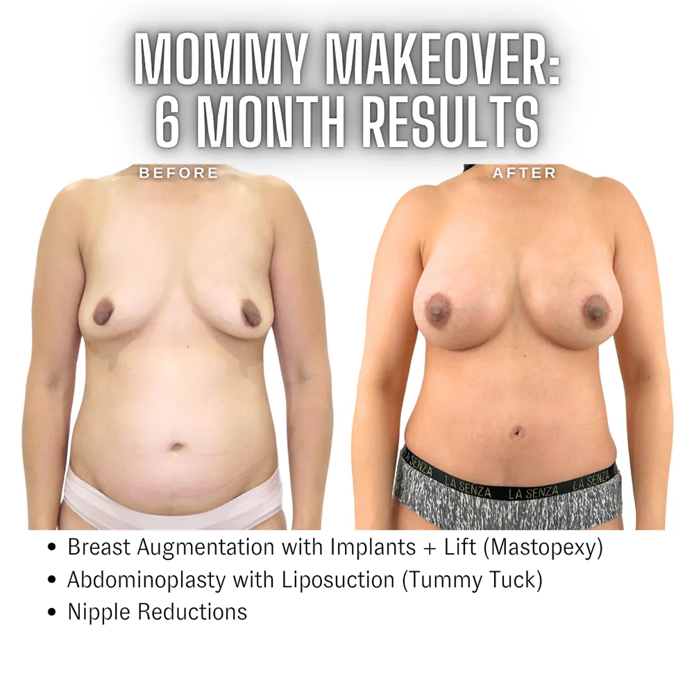 Mommy_Makeover_Toronto_Ontario9