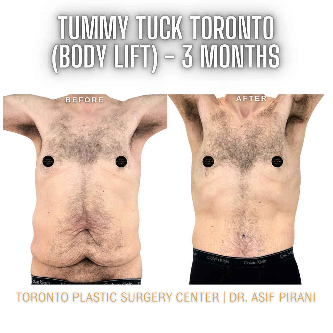 Tummy_Tuck_Toronto_Abdominoplasty1