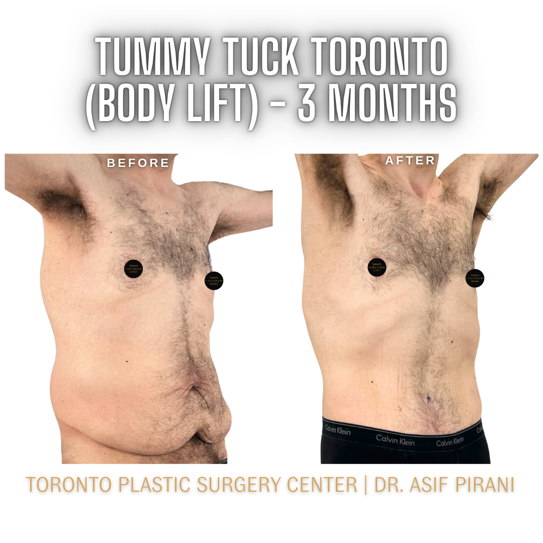 Tummy_Tuck_Toronto_Abdominoplasty2