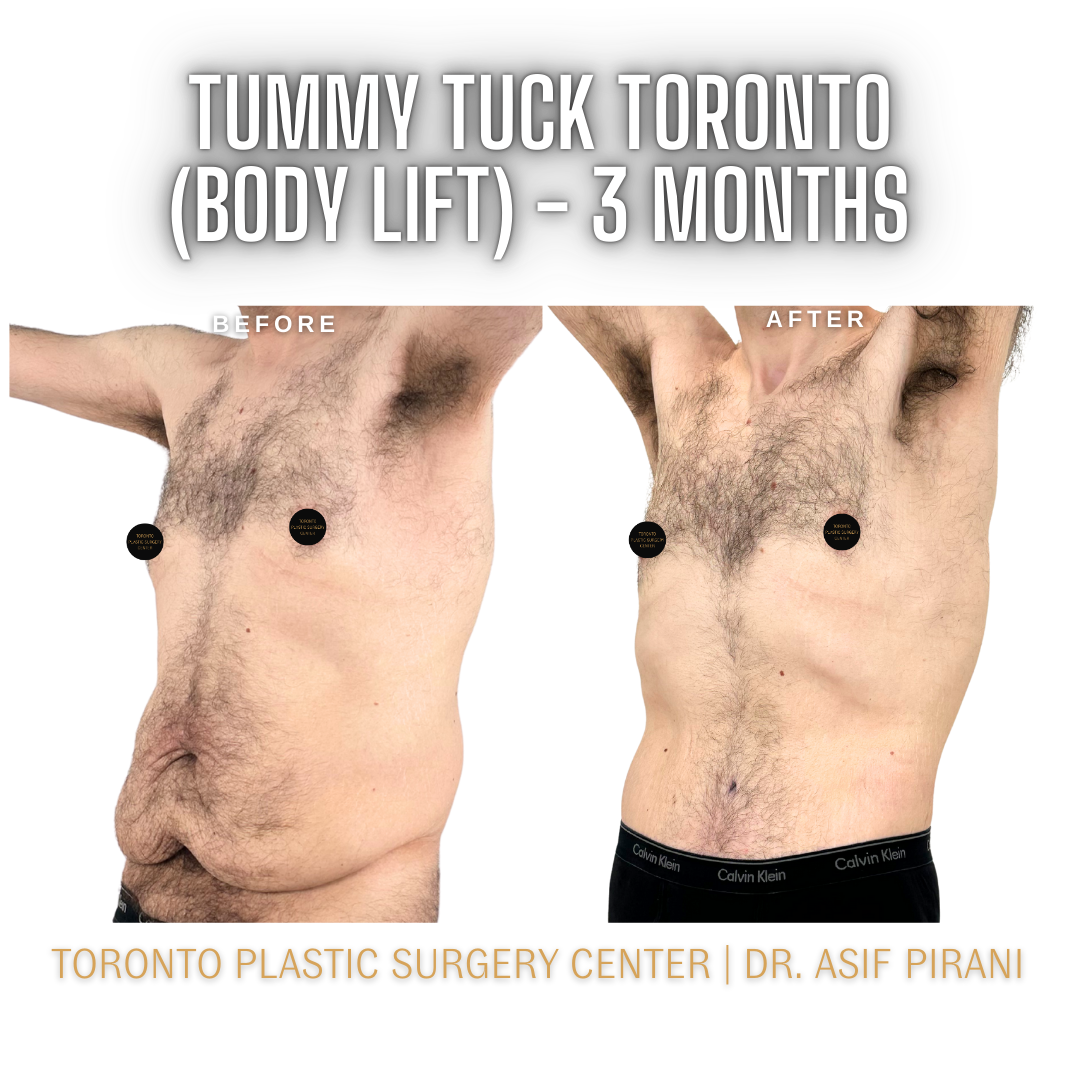 Tummy_Tuck_Toronto_Abdominoplasty3