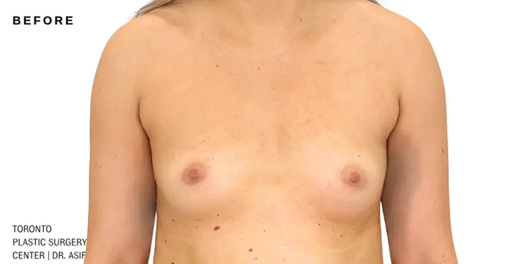 25742-breast-aug-01