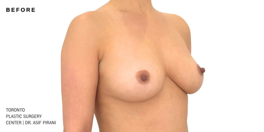 breast-augmentation-3